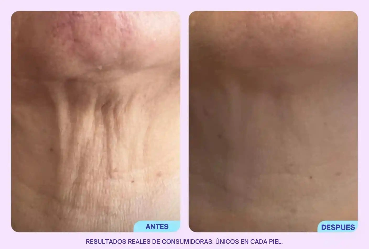 GoPure - Reafirma y transforma tu cuello.